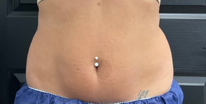 CoolSculpting Before & After Patient #2723