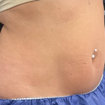 CoolSculpting Before & After Patient #2723