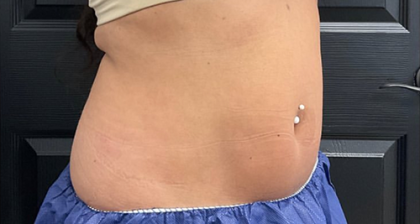 CoolSculpting Before & After Patient #2723