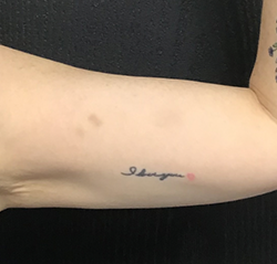 CoolSculpting Before & After Patient #2889