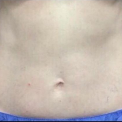 CoolSculpting Before & After Patient #2895
