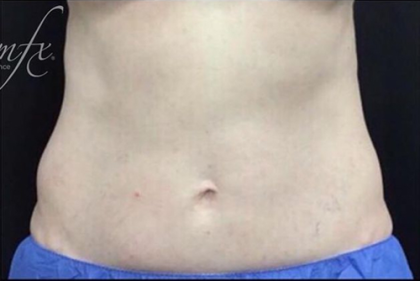 CoolSculpting Before & After Patient #2895