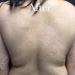 CoolSculpting Before & After Patient #2893