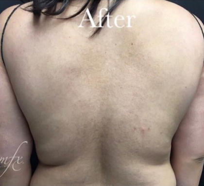CoolSculpting Before & After Patient #2893