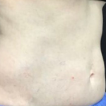 CoolSculpting Before & After Patient #2892