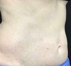 CoolSculpting Before & After Patient #2892