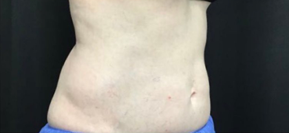 CoolSculpting Before & After Patient #2892