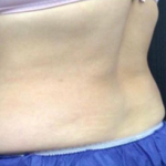 CoolSculpting Before & After Patient #2896