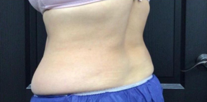 CoolSculpting Before & After Patient #2896