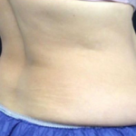 CoolSculpting Before & After Patient #2896