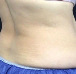 CoolSculpting Before & After Patient #2896
