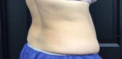 CoolSculpting Before & After Patient #2896