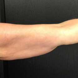 CoolSculpting Before & After Patient #2879