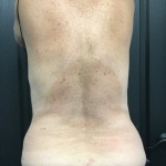 CoolSculpting Before & After Patient #2873