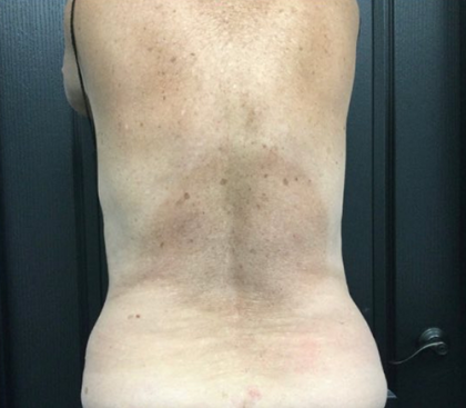 CoolSculpting Before & After Patient #2873