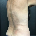 CoolSculpting Before & After Patient #2873