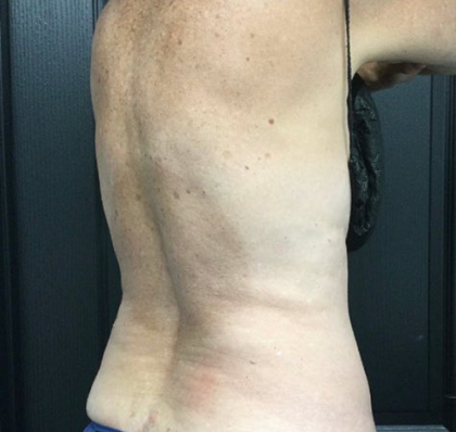 CoolSculpting Before & After Patient #2873