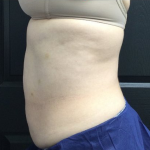 CoolSculpting Before & After Patient #2872