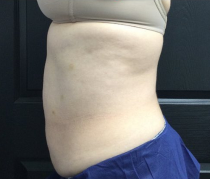 CoolSculpting Before & After Patient #2872