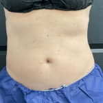 CoolSculpting Before & After Patient #2872