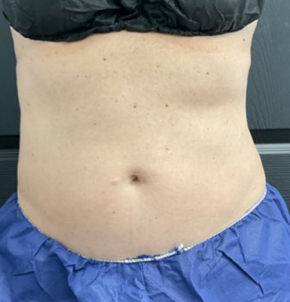 CoolSculpting Before & After Patient #2872