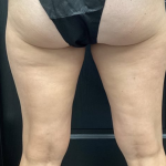 CoolSculpting Before & After Patient #2870