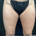 CoolSculpting Before & After Patient #2870