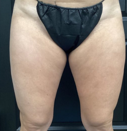 CoolSculpting Before & After Patient #2870