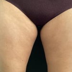 CoolSculpting Before & After Patient #2869