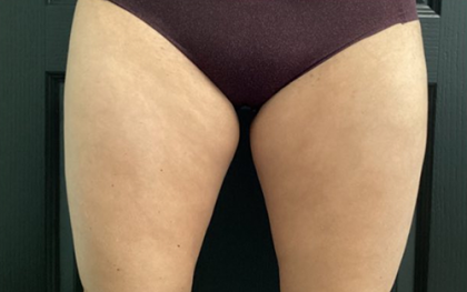 CoolSculpting Before & After Patient #2869