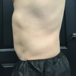 CoolSculpting Before & After Patient #2868