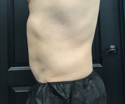 CoolSculpting Before & After Patient #2868