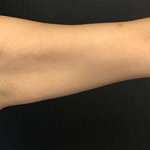 CoolSculpting Before & After Patient #2867