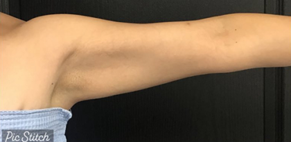 CoolSculpting Before & After Patient #2867