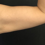 CoolSculpting Before & After Patient #2867