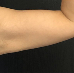 CoolSculpting Before & After Patient #2867
