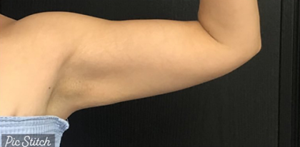 CoolSculpting Before & After Patient #2867