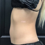 CoolSculpting Before & After Patient #2866