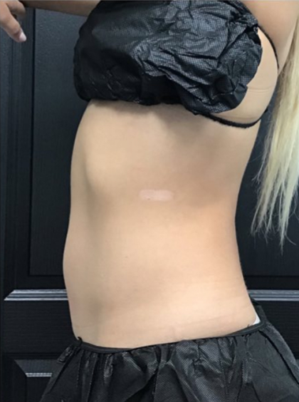 CoolSculpting Before & After Patient #2866