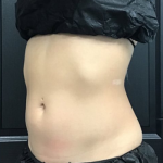 CoolSculpting Before & After Patient #2866