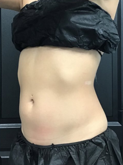 CoolSculpting Before & After Patient #2866