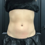 CoolSculpting Before & After Patient #2865