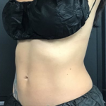 CoolSculpting Before & After Patient #2865