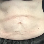 CoolSculpting Before & After Patient #2864