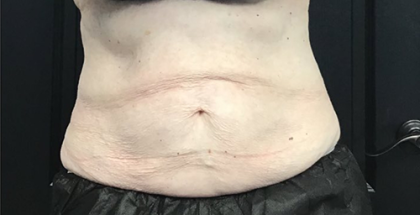 CoolSculpting Before & After Patient #2864