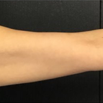 CoolSculpting Before & After Patient #2863