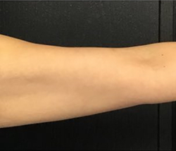 CoolSculpting Before & After Patient #2863