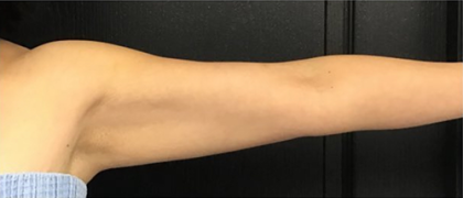 CoolSculpting Before & After Patient #2863