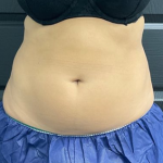 CoolSculpting Before & After Patient #2862