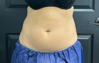 CoolSculpting Before & After Patient #2862